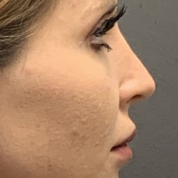 After Image: SeptoRhinoplasty by Dr. Thompson - right-side