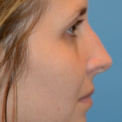 Before Image: SeptoRhinoplasty by Dr. Thompson - right-side
