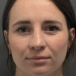 After Image: Revision Rhinoplasty by Dr. Henstrom - front