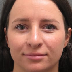 Before Image: Revision Rhinoplasty by Dr. Henstrom - front