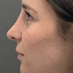 After Image: Revision Rhinoplasty by Dr. Henstrom - left-side