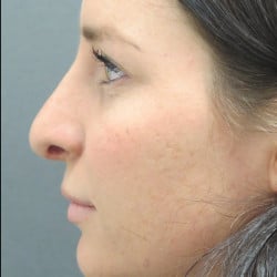 Before Image: Revision Rhinoplasty by Dr. Henstrom - left-side