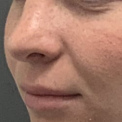 After Image: Revision Rhinoplasty by Dr. Henstrom - left-front-oblique