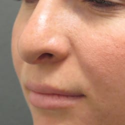 Before Image: Revision Rhinoplasty by Dr. Henstrom - left-front-oblique