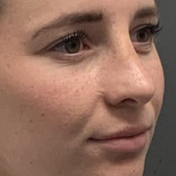 After Image: Revision Rhinoplasty by Dr. Henstrom - right-front-oblique