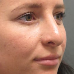 Before Image: Revision Rhinoplasty by Dr. Henstrom - right-front-oblique
