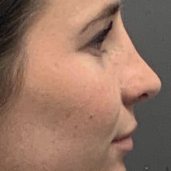 After Image: Revision Rhinoplasty by Dr. Henstrom - right-side