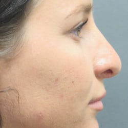 Before Image: Revision Rhinoplasty by Dr. Henstrom - right-side