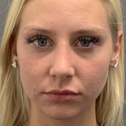 After Image: Rhinoplasty by Dr. Henstrom - front