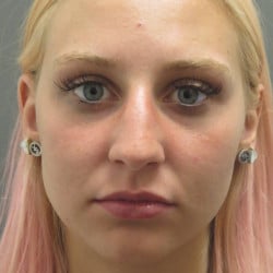Before Image: Rhinoplasty by Dr. Henstrom - front