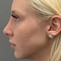 After Image: Rhinoplasty by Dr. Henstrom - left-side