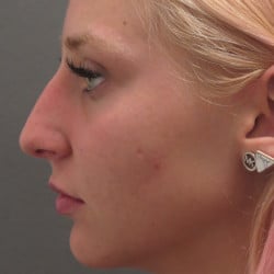 Before Image: Rhinoplasty by Dr. Henstrom - left-side