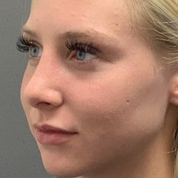 After Image: Rhinoplasty by Dr. Henstrom - left-front-oblique