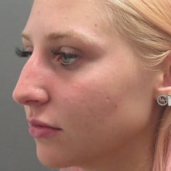 Before Image: Rhinoplasty by Dr. Henstrom - left-front-oblique