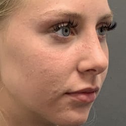 After Image: Rhinoplasty by Dr. Henstrom - right-front-oblique