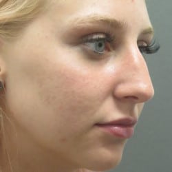 Before Image: Rhinoplasty by Dr. Henstrom - right-front-oblique