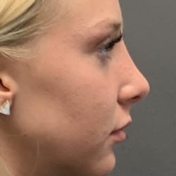 After Image: Rhinoplasty by Dr. Henstrom - right-side