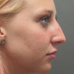 Before Image: Rhinoplasty by Dr. Henstrom - right-side