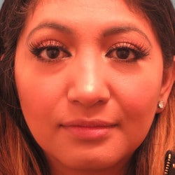 After Image: Septorhinoplasty by Dr. Henstrom - front