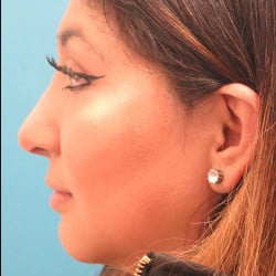 After Image: Septorhinoplasty by Dr. Henstrom - left-side