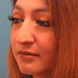 Before Image: Septorhinoplasty by Dr. Henstrom - left-front-oblique