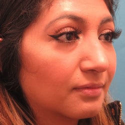 After Image: Septorhinoplasty by Dr. Henstrom - right-front-oblique
