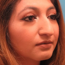 Before Image: Septorhinoplasty by Dr. Henstrom - right-front-oblique