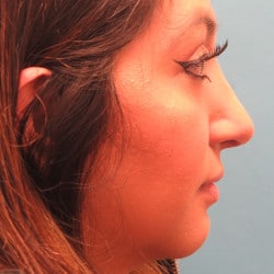 After Image: Septorhinoplasty by Dr. Henstrom - right-side