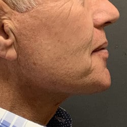 After Image: Neck Lift by Dr. Henstrom