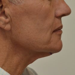 Before Image: Neck Lift by Dr. Henstrom