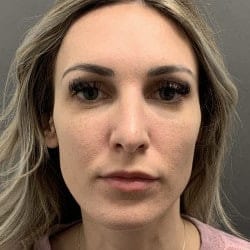 After Image: Rhinoplasty by Dr. Henstrom - front