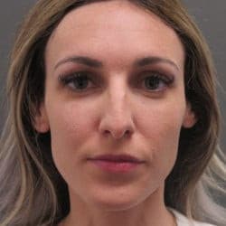 Before Image: Rhinoplasty by Dr. Henstrom - front