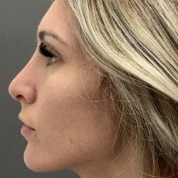 After Image: Rhinoplasty by Dr. Henstrom - left-side