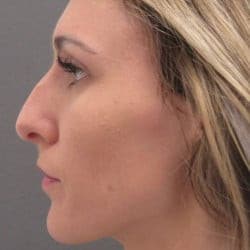Before Image: Rhinoplasty by Dr. Henstrom - left-side
