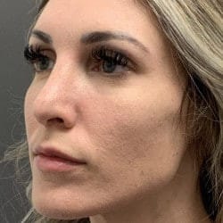After Image: Rhinoplasty by Dr. Henstrom - left-front-oblique