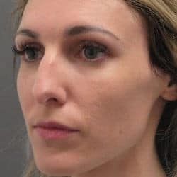 Before Image: Rhinoplasty by Dr. Henstrom - left-front-oblique