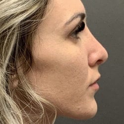 After Image: Rhinoplasty by Dr. Henstrom - right-side