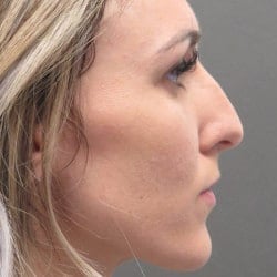 Before Image: Rhinoplasty by Dr. Henstrom - right-side