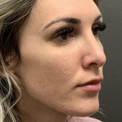 After Image: Rhinoplasty by Dr. Henstrom - right-front-oblique
