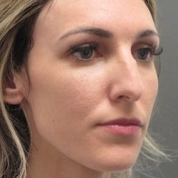 Before Image: Rhinoplasty by Dr. Henstrom - right-front-oblique
