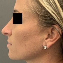 After Image: Rhinoplasty by Dr. Henstrom - left-side