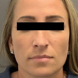 After Image: Rhinoplasty by Dr. Henstrom - front
