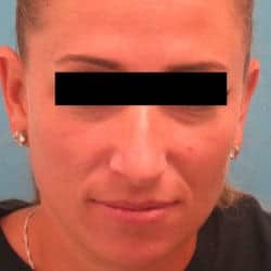 Before Image: Rhinoplasty by Dr. Henstrom - front
