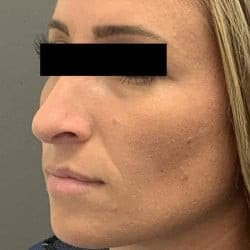 After Image: Rhinoplasty by Dr. Henstrom - left-front-oblique