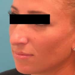Before Image: Rhinoplasty by Dr. Henstrom - left-front-oblique