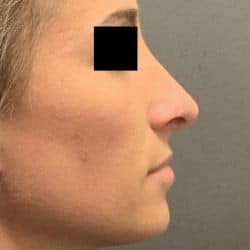 After Image: Rhinoplasty by Dr. Henstrom - right-side
