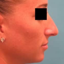 Before Image: Rhinoplasty by Dr. Henstrom - right-side