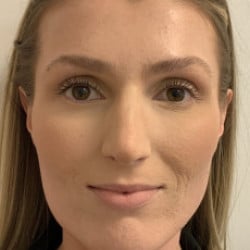 After Image: Rhinoplasty by Dr. Henstrom - front