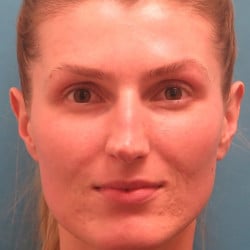 Before Image: Rhinoplasty by Dr. Henstrom - front