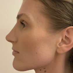 After Image: Rhinoplasty by Dr. Henstrom - left-side